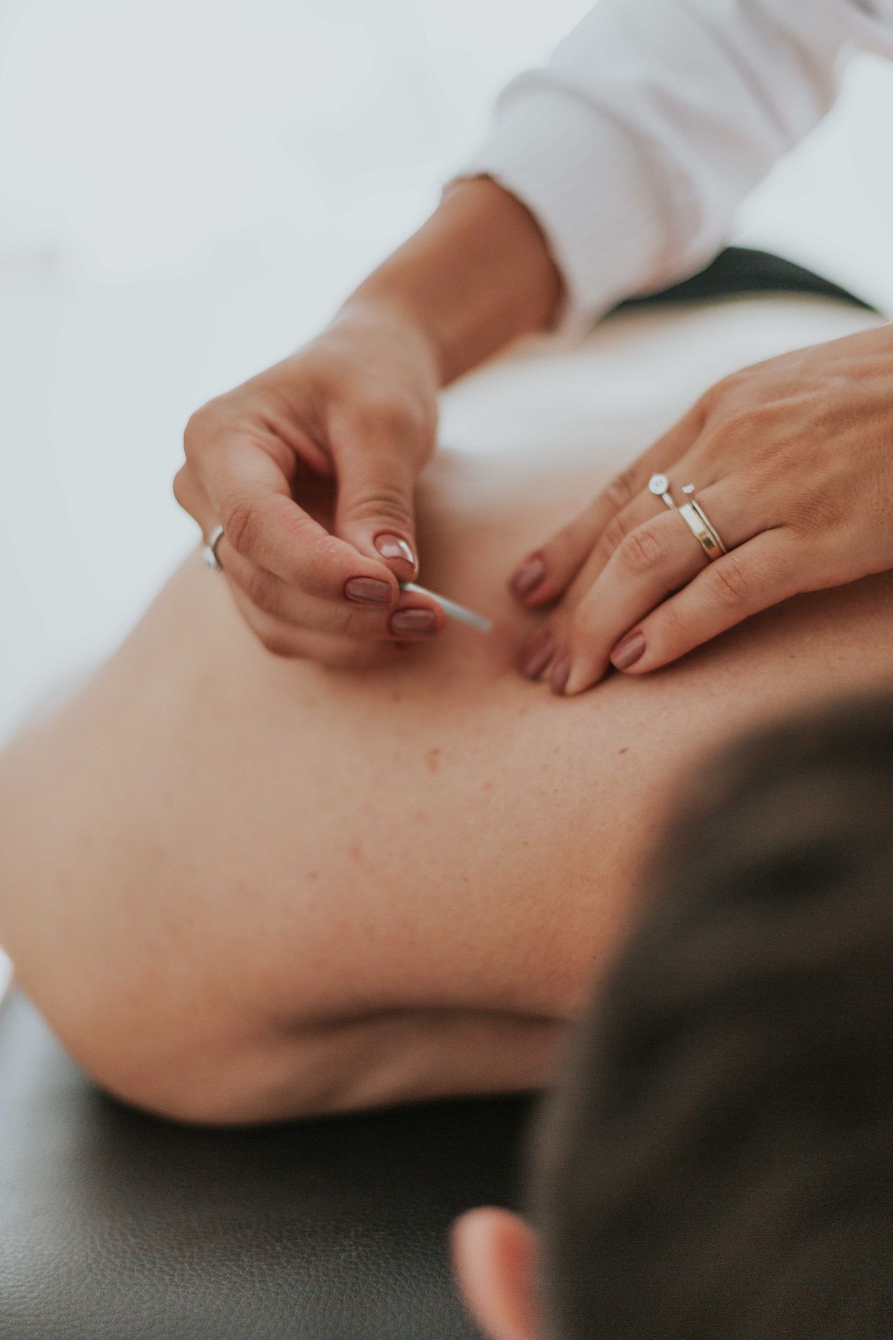 acupuncture for pain relief